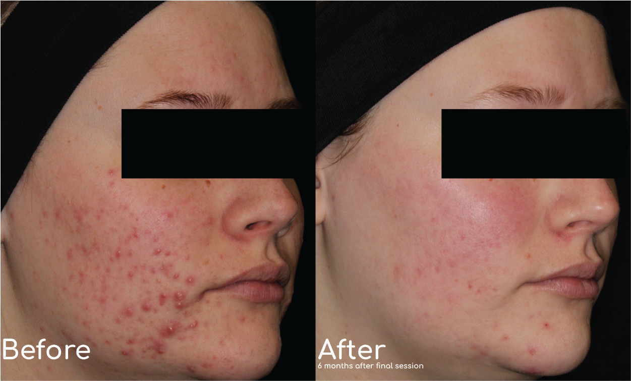 Aviclear acne treatment results in san antonio, texas