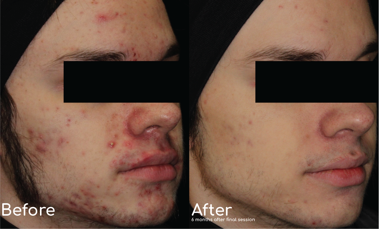 Aviclear acne treatment Results in san antonio