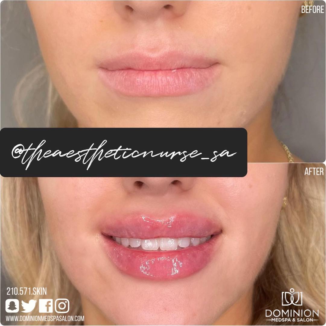 Versa lip Filler San Antonio Texas