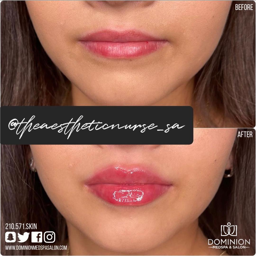 Versa lip Filler San Antonio Texas