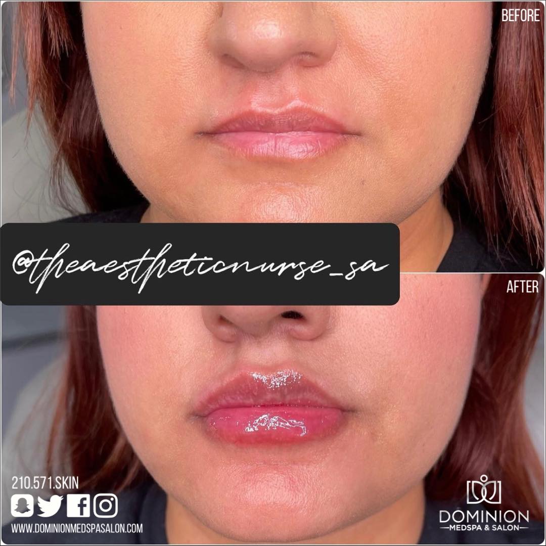 Versa lip Filler San Antonio Texas