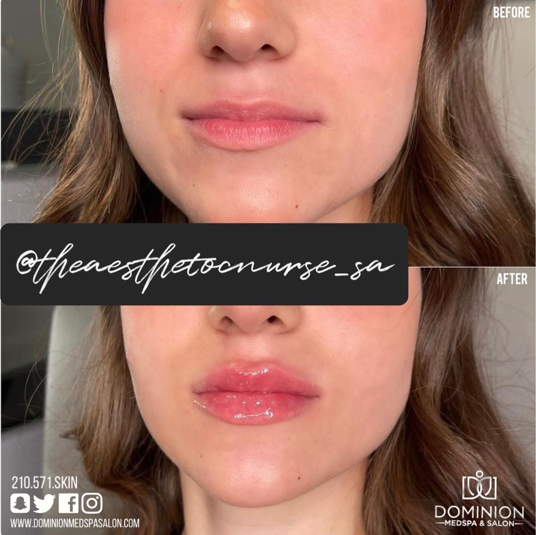 Versa lip Filler San Antonio Texas