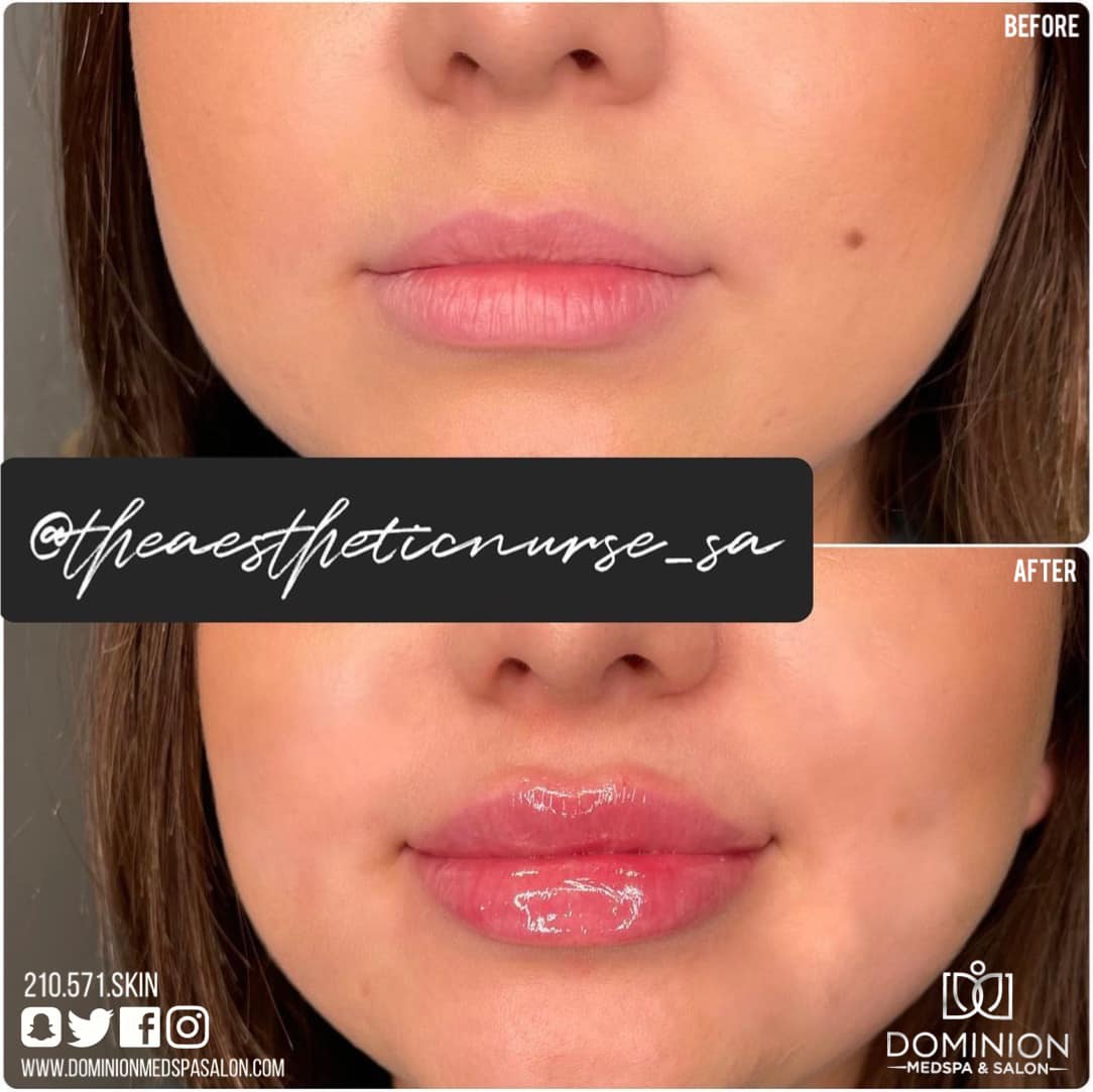 Versa Lip Filler in San Antonio Texas