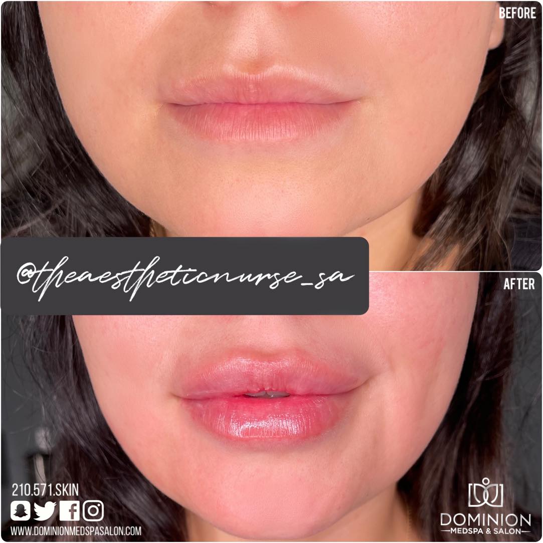 Versa Lip Filler Results San Antonio