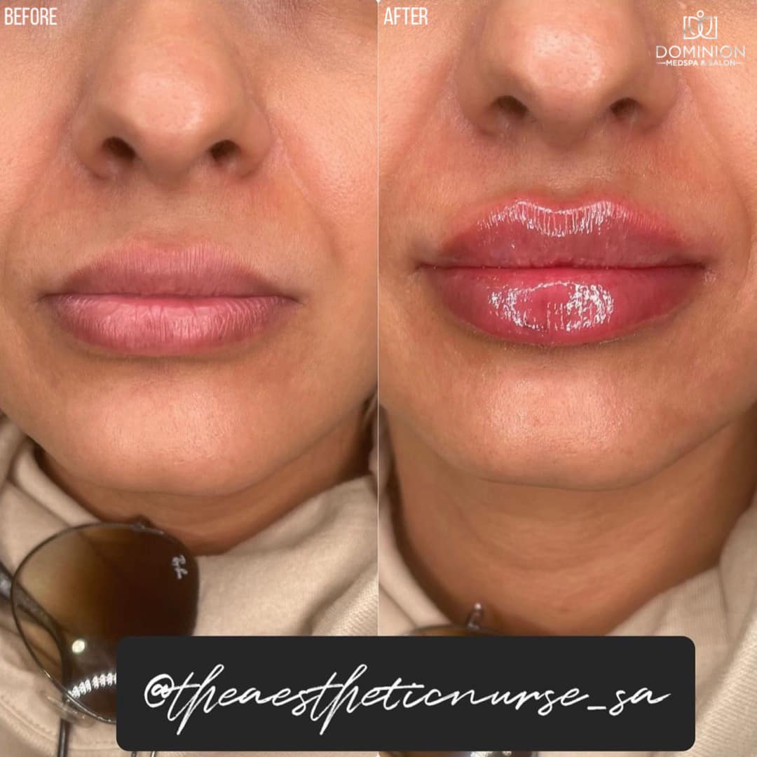 Versa lip Filler San Antonio Texas