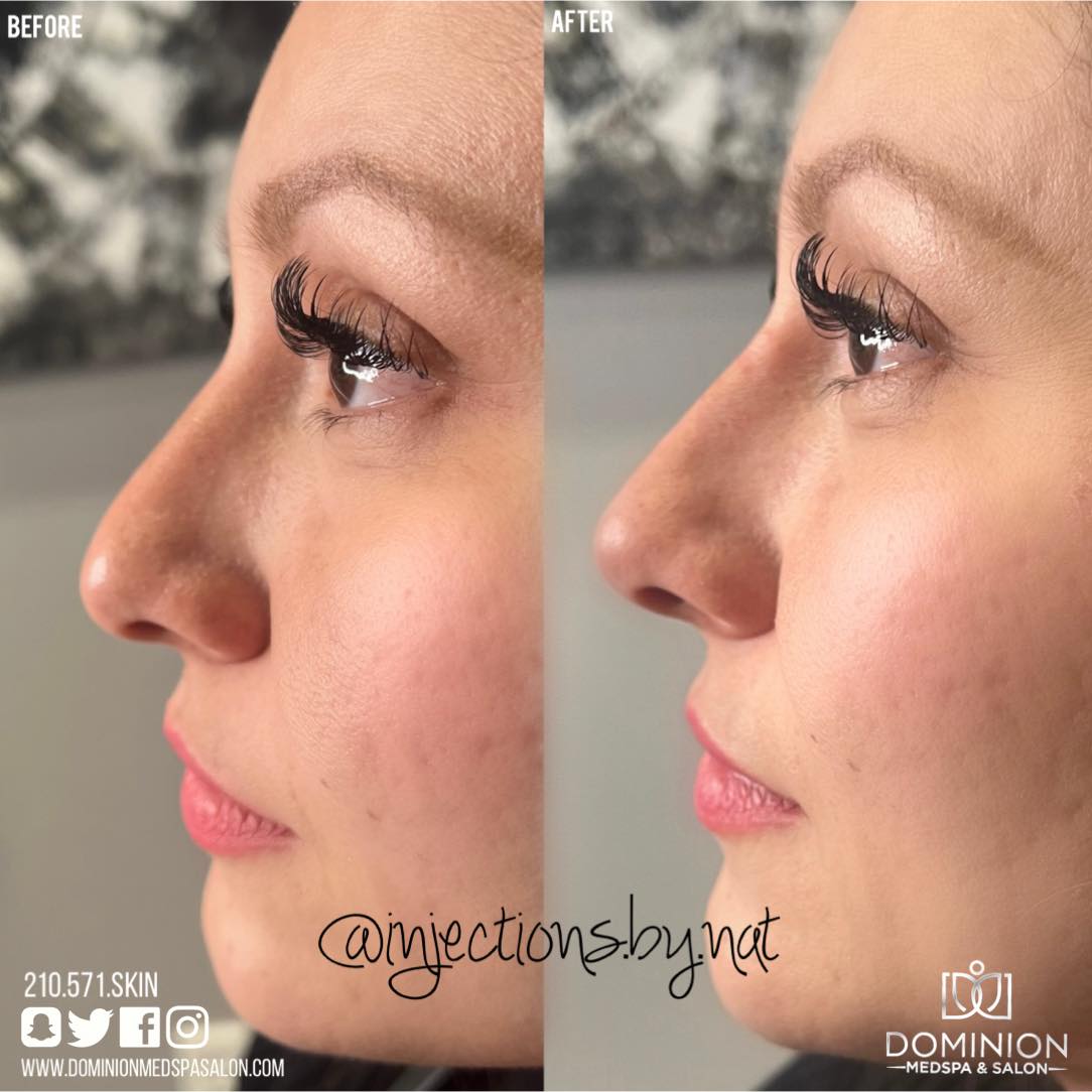 Non-Surgical Rhinoplasty in San Antonio, TX