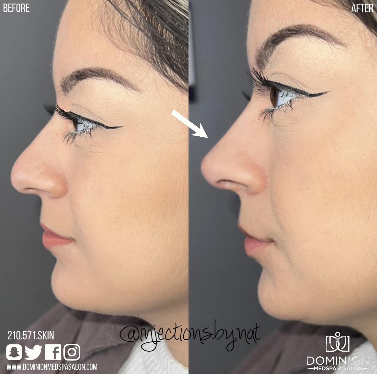 Nose Filler San Antonio Texas